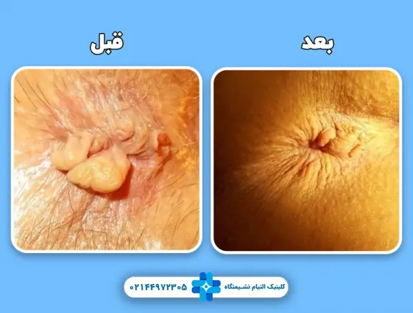  فیلم و عکس جراحی گوشت اضافه مقعدی