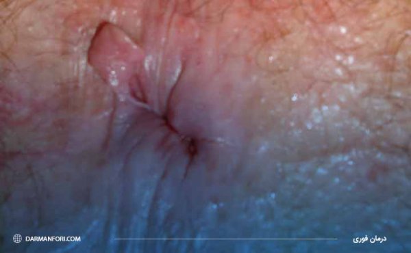  فیلم و عکس جراحی گوشت اضافه مقعدی