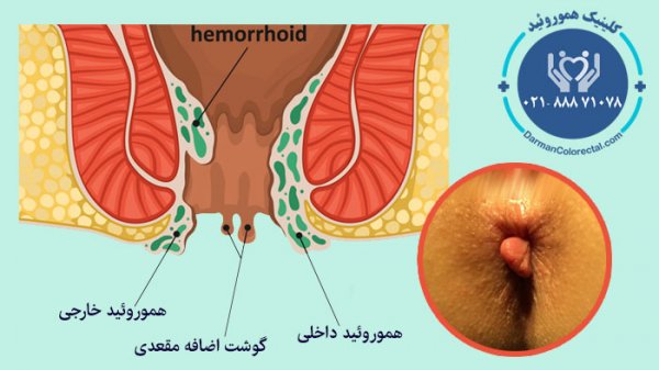  فیلم و عکس جراحی گوشت اضافه مقعدی