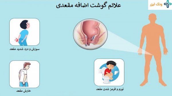  فیلم و عکس جراحی گوشت اضافه مقعدی