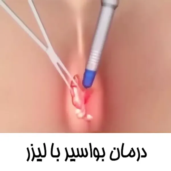 فیلم عمل بواسیر زنان با لیزر بدون سانسور