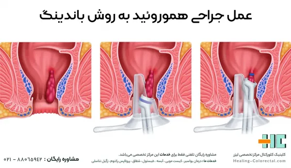  فیلم عمل بواسیر زنان با لیزر بدون سانسور