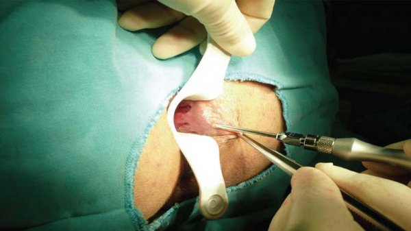  فیلم عمل بواسیر زنان با لیزر بدون سانسور