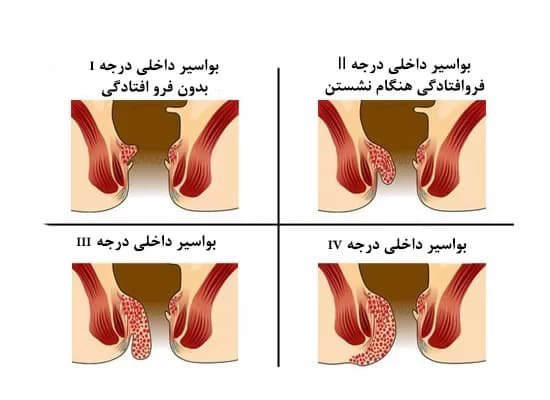  آیا بواسیر داخلی نیاز به عمل دارد؟