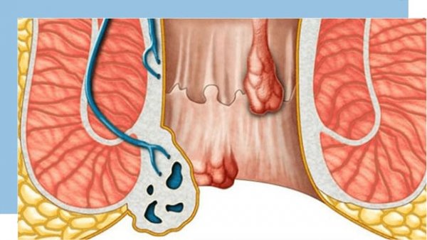  آیا بواسیر داخلی نیاز به عمل دارد؟