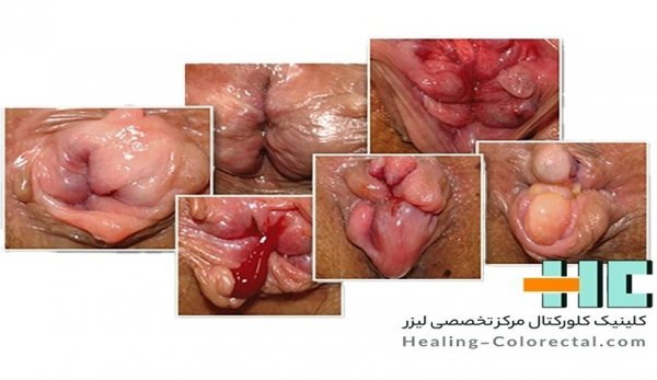  آیا بواسیر داخلی نیاز به عمل دارد؟