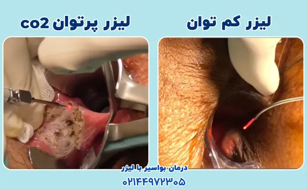  آیا بواسیر داخلی نیاز به عمل دارد؟