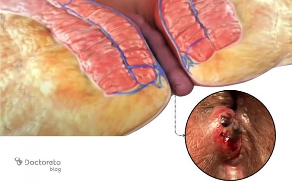  آیا بواسیر داخلی نیاز به عمل دارد؟