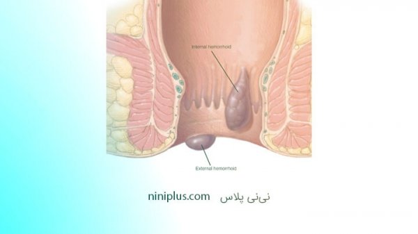  عکس بواسیر در بارداری