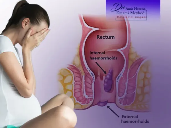  عکس بواسیر در بارداری