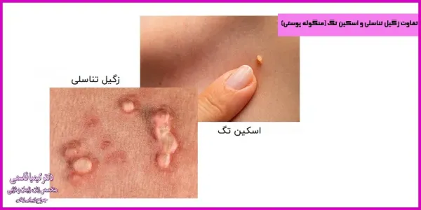  آیا گوشت اضافه همان زگیل تناسلی است؟