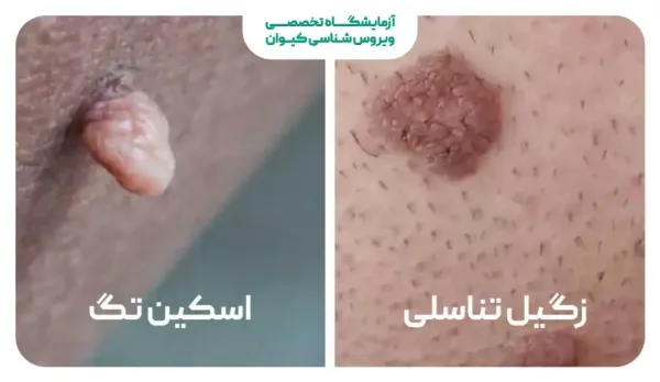  آیا گوشت اضافه همان زگیل تناسلی است؟