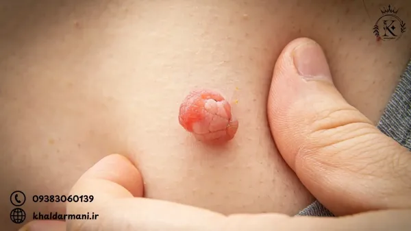  آیا گوشت اضافه همان زگیل تناسلی است؟