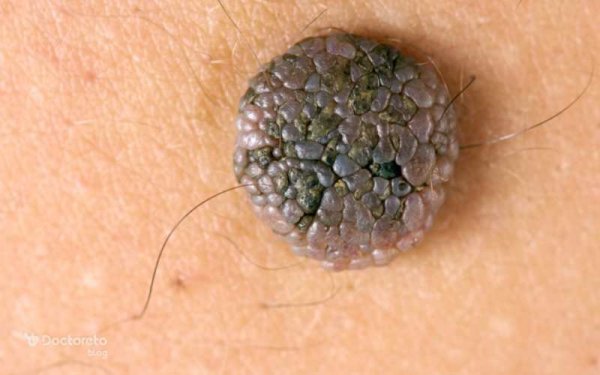  آیا گوشت اضافه همان زگیل تناسلی است؟