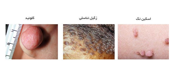  آیا گوشت اضافه همان زگیل تناسلی است؟