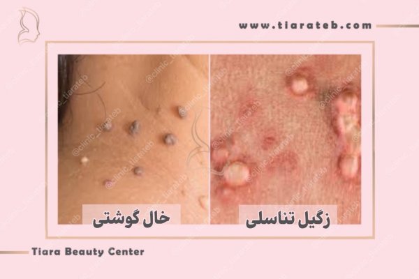  آیا گوشت اضافه همان زگیل تناسلی است؟