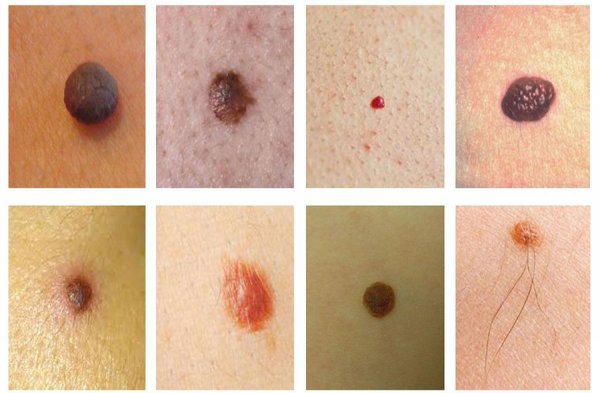  آیا گوشت اضافه همان زگیل تناسلی است؟