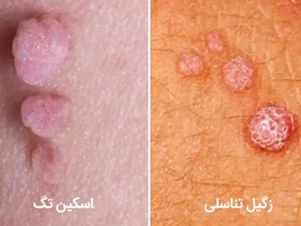  آیا گوشت اضافه همان زگیل تناسلی است؟