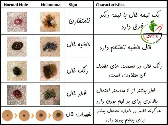  از کجا بفهمیم خال سرطانی است؟
