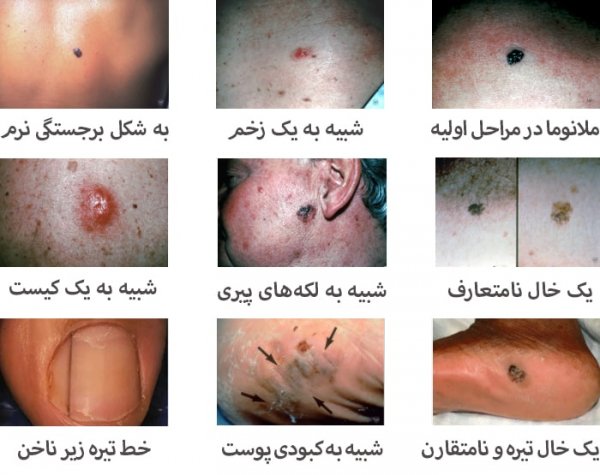  از کجا بفهمیم خال سرطانی است؟