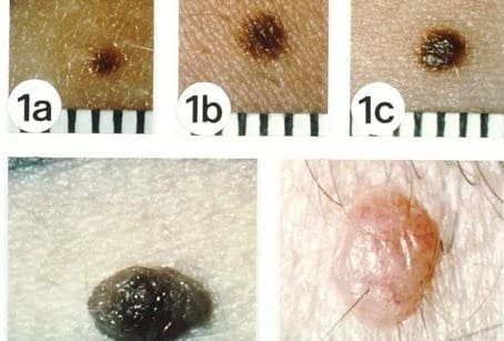  از کجا بفهمیم خال سرطانی است؟