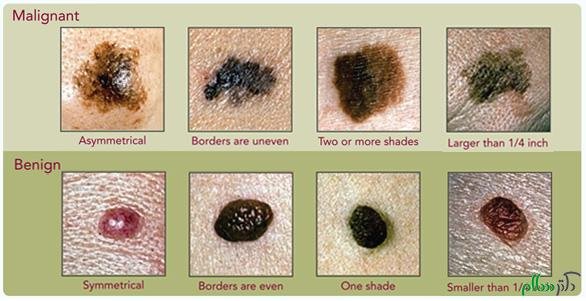  عکس خال های سرطانی