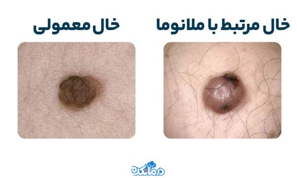  عکس خال های سرطانی