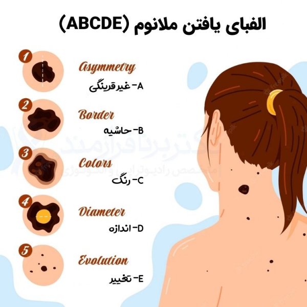  عکس خال های سرطانی