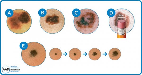  عکس خال های سرطانی