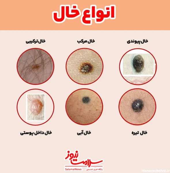  عکس خال های سرطانی