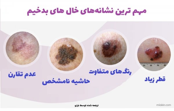  عکس خال های سرطانی