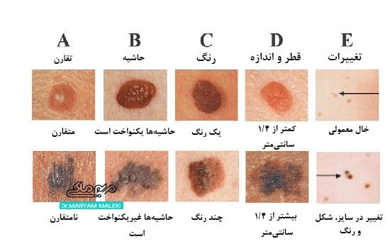  عکس خال های سرطانی