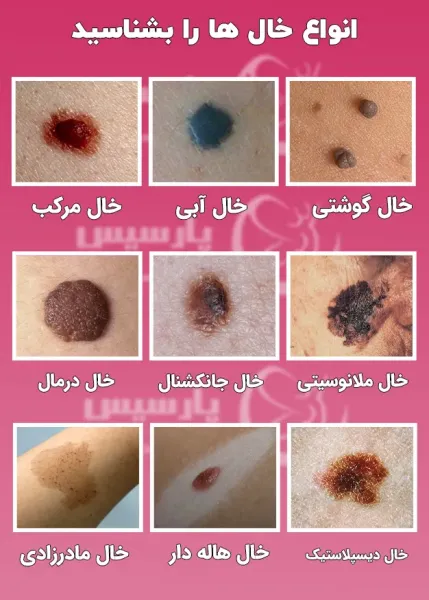  عکس خالهای گوشتی سرطانی