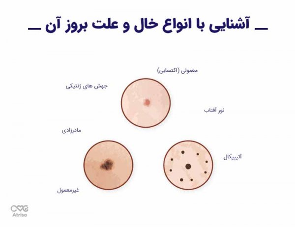 عکس خالهای گوشتی سرطانی