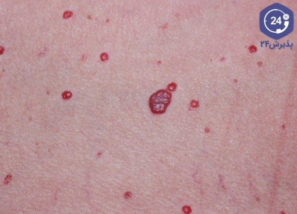  بزرگ شدن خال گوشتی نشانه چیست؟