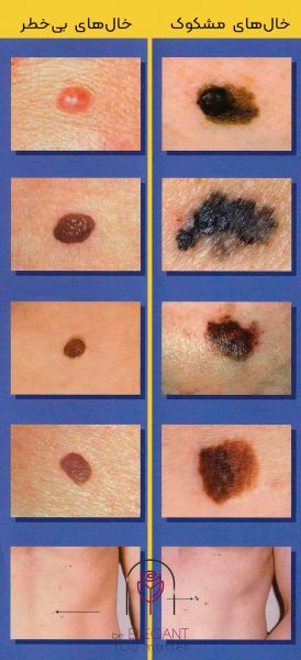  بزرگ شدن خال گوشتی نشانه چیست؟