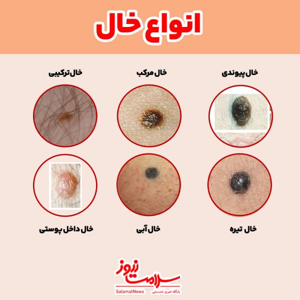  بزرگ شدن خال گوشتی نشانه چیست؟