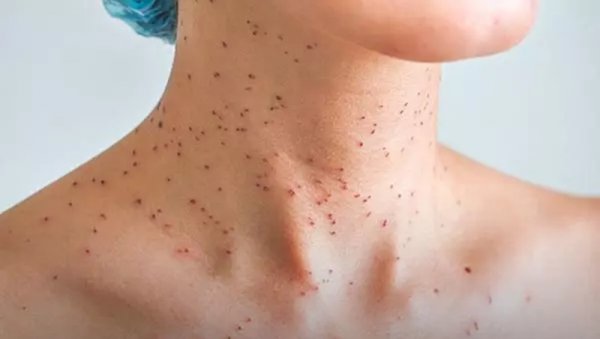  بزرگ شدن خال گوشتی نشانه چیست؟