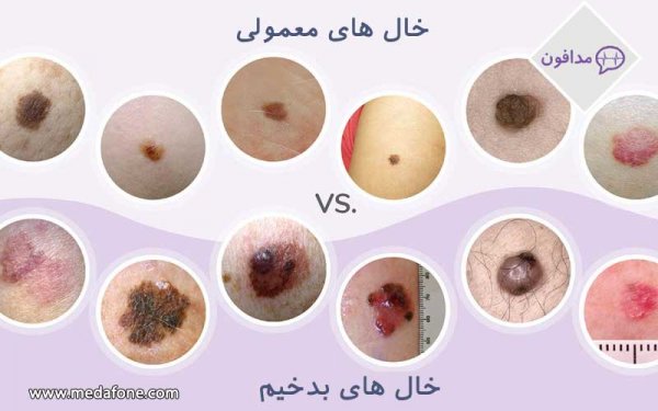  بزرگ شدن خال گوشتی نشانه چیست؟