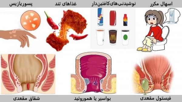  درمان خشکی مقعدی