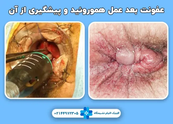  درمان خشکی مقعدی