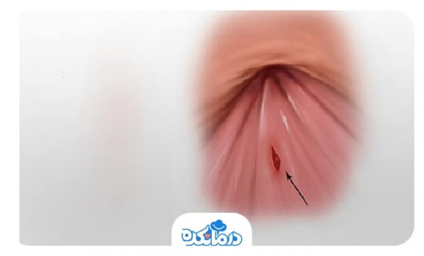  درمان خشکی مقعدی