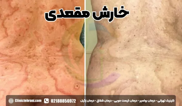 خارش مقعدی نشانه چیست؟