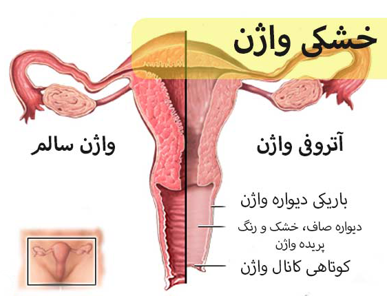 درمان خشکی پوست اطراف واژن