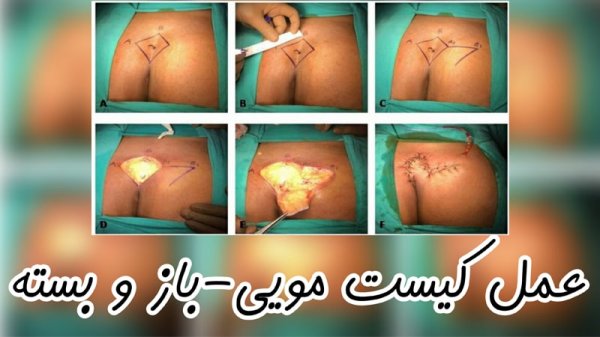 عمل سینوس پیلونیدال / کیست مویی به روش باز