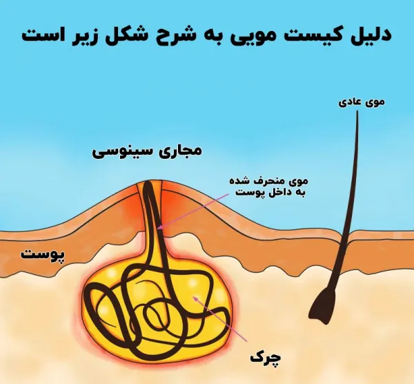  عمل سینوس پیلونیدال / کیست مویی به روش باز