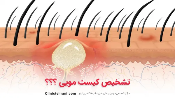 از کجا بفهمیم که کیست مویی داریم؟
