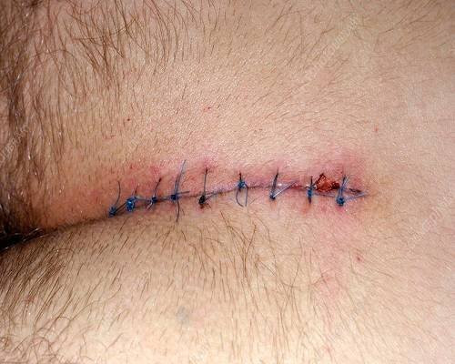  هزینه عمل کیست مویی با دفترچه تامین اجتماعی