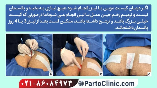  هزینه عمل کیست مویی با دفترچه تامین اجتماعی