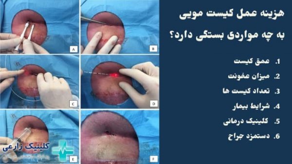  هزینه عمل کیست مویی با دفترچه تامین اجتماعی